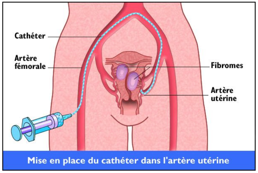 EMBOLISATION DES FIBROMES,  FERTILITÉ ET GROSSESSE